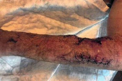 Skambitt av politihund - sak mot politimann henlagt av Spesialenheten